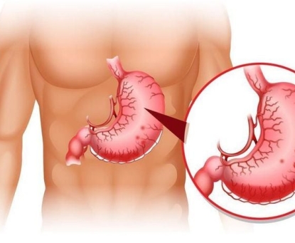 Tại sao bạn lại có thể bị ung thư dạ dày